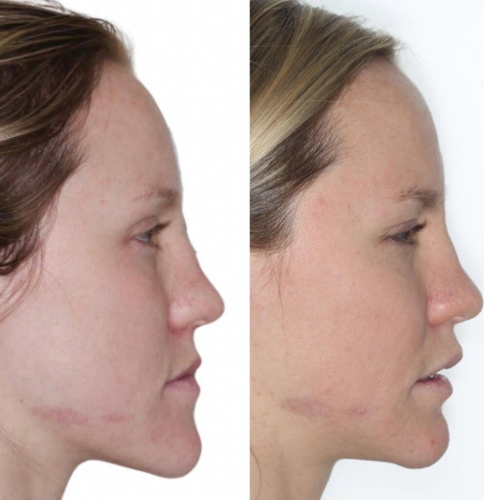 Side profile of an adult woman before and after Invisalign and jaw surgery, showing a more forward lower jaw
