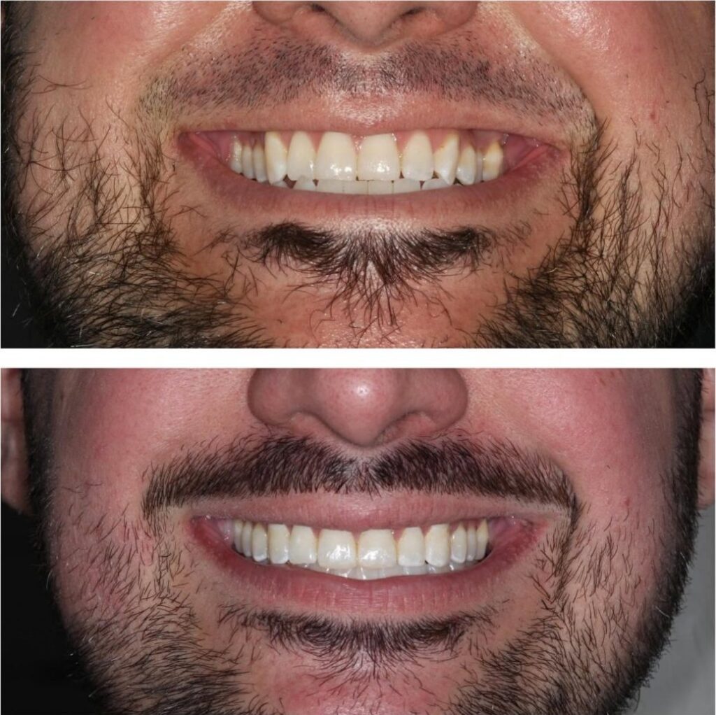 Adult man's smile before and after orthodontic treatment, with crowded front teeth straightened