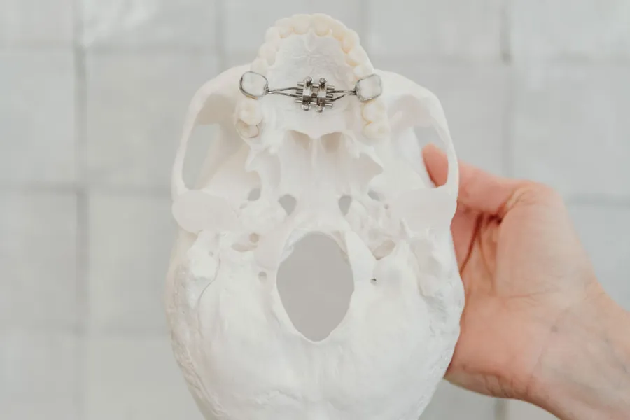 Skull model showing a MARPE appliance used for adult palate expansion in Denver